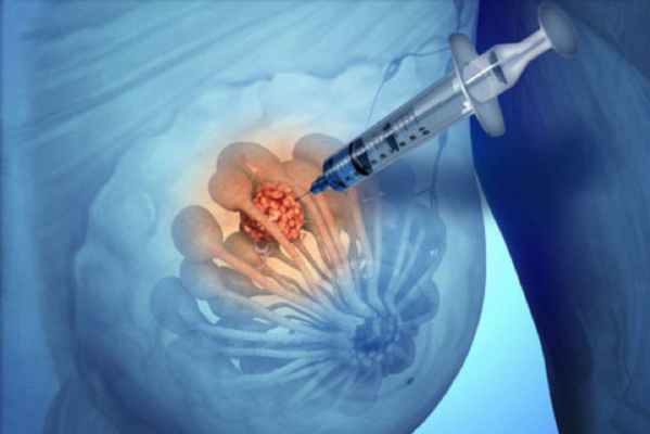 Биопсия молочной железы