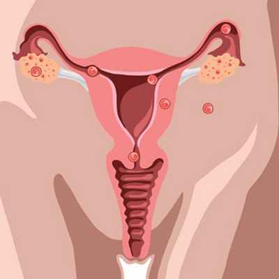 Эктопия шейки матки