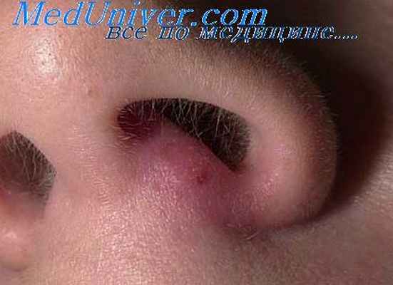 карбункул носа