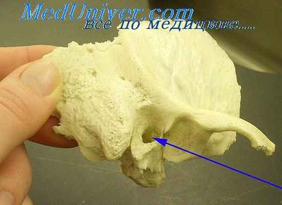 экзостоз наружного слухового прохода