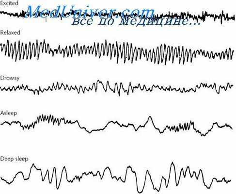 электроэнцефалограмма