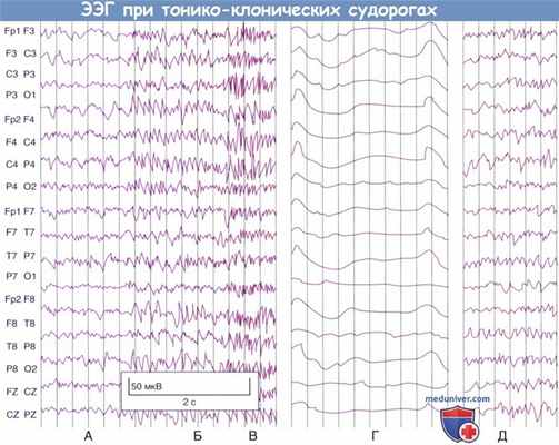 ЭЭГ при тонико-клонических судорогах