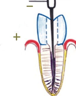 Электрофорез зубов: что это такое?