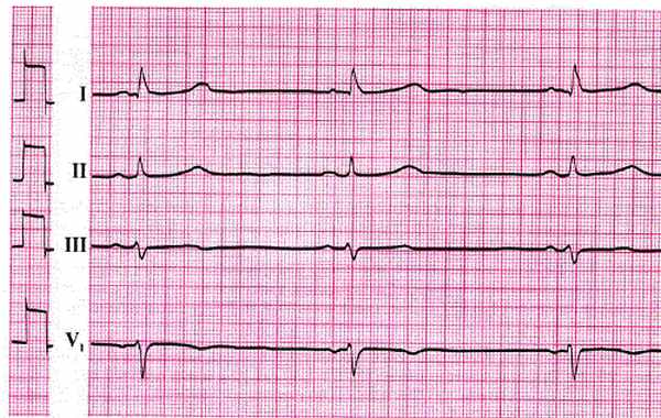 Брадикардия