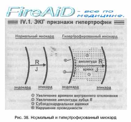 признаки гипертрофии миокарда