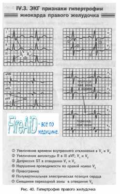 признаки гипертрофии миокарда правого желудочка