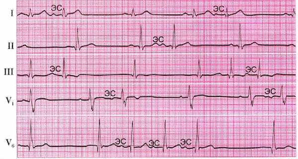 Экстрасистолия