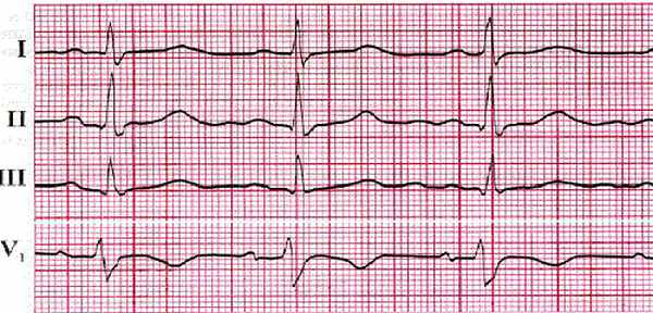 Тахикардия