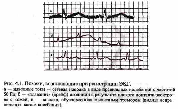 Какие проблемы могут возникнуть при регистрации ЭКГ