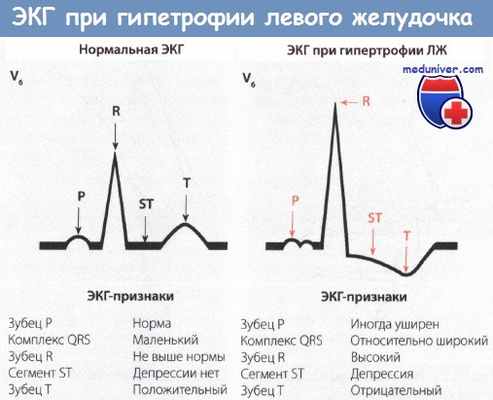 ЭКГ при гипетрофии левого желудочка сердца