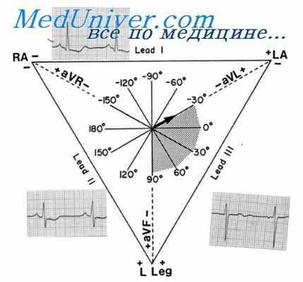 декстрокардии