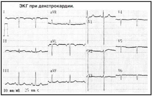 Пример электрокардиограммы