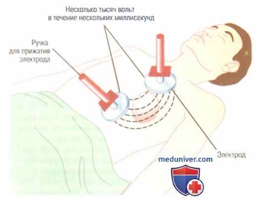 Электрошоковая дефибрилляция желудочков