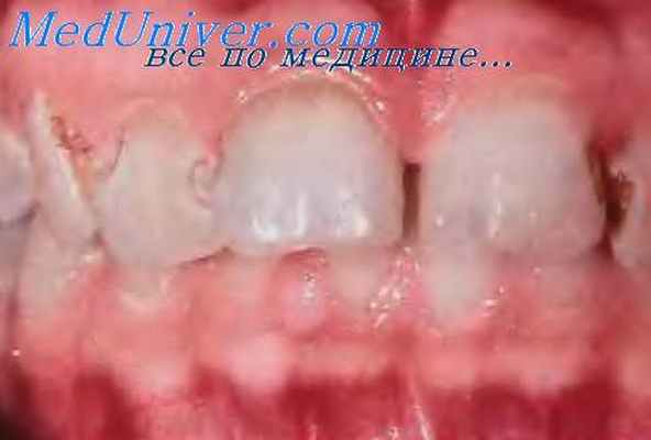 окрашивание в стоматологии