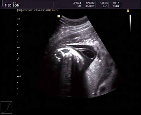 Эхограмма - эхогенность ликвора ниже эхогенности околоплодных вод, беременность 30 недель