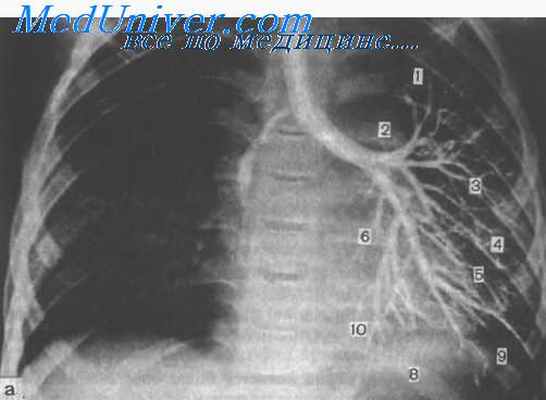 гемоторакс