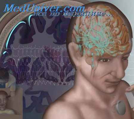 височная эпилепсия