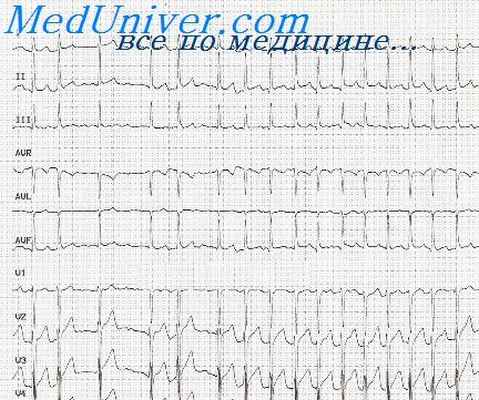 желудочковая тахикардия