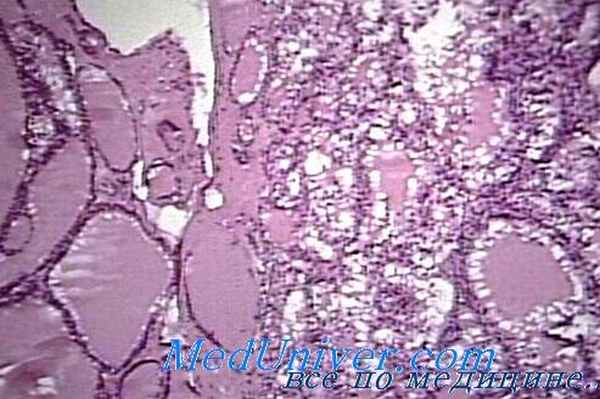 патологическая анатомия зоба