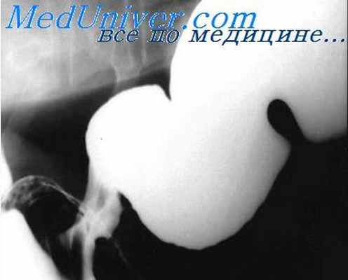 опухоли пищевода