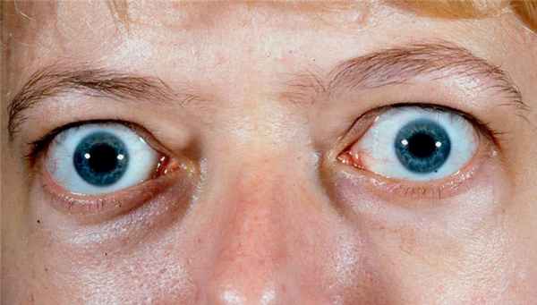 Эндокринная офтальмопатия