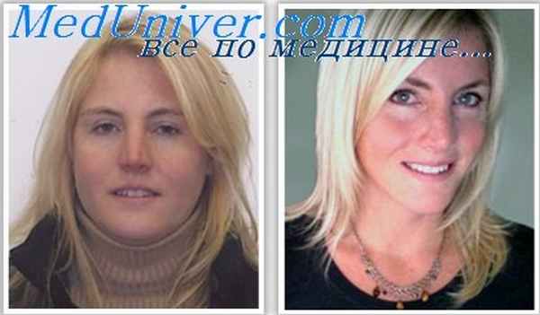 гипотиреоз при пороке сердца