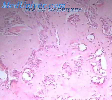 рак гортани