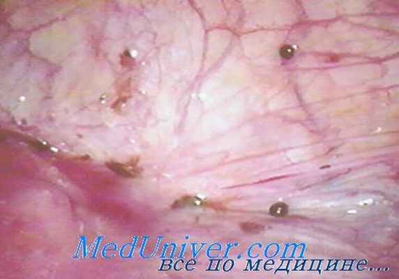 эндометриоз