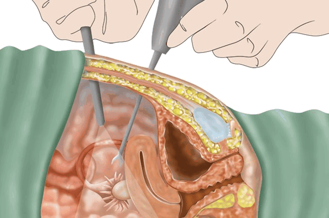 операция при эндометриозе
