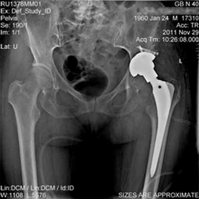 Эндопротезирование тазобедренного сустава