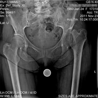 Эндопротезирование тазобедренного сустава
