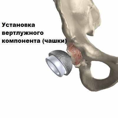 Эндопротезирование тазобедренного сустава