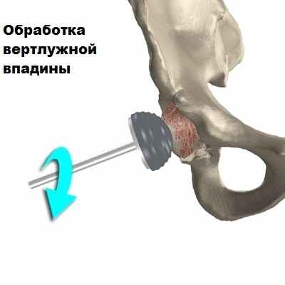 Эндопротезирование тазобедренного сустава