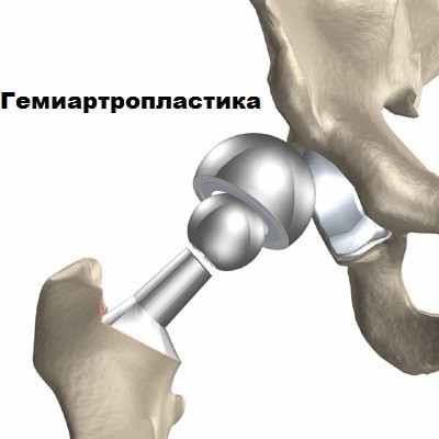 Эндопротезирование тазобедренного сустава