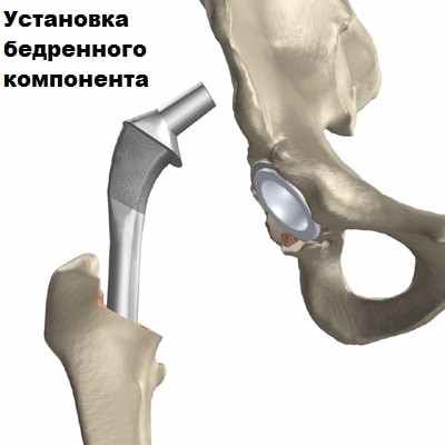 Эндопротезирование тазобедренного сустава