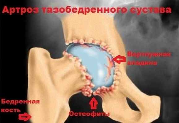 Эндопротезирование тазобедренного сустава
