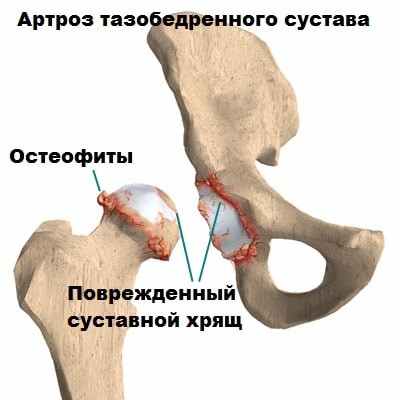 Эндопротезирование тазобедренного сустава