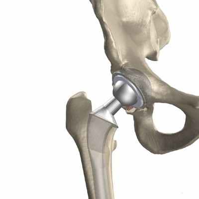 Эндопротезирование тазобедренного сустава