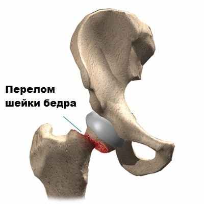 Эндопротезирование тазобедренного сустава