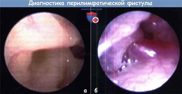 Диагностика перилимфатической фистулы