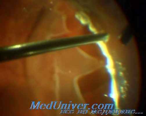 диатермия сетчатки