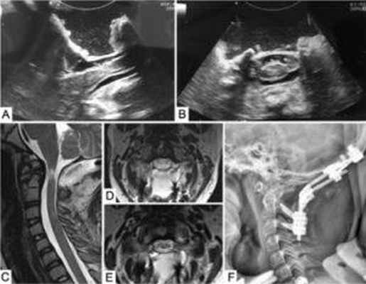лечение базилярной импрессии и аномалии Киари