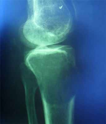 Новообразования костей9.jpg