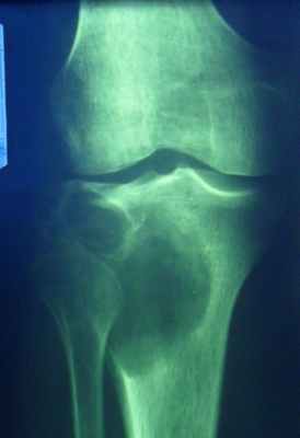 Новообразования костей12.jpg