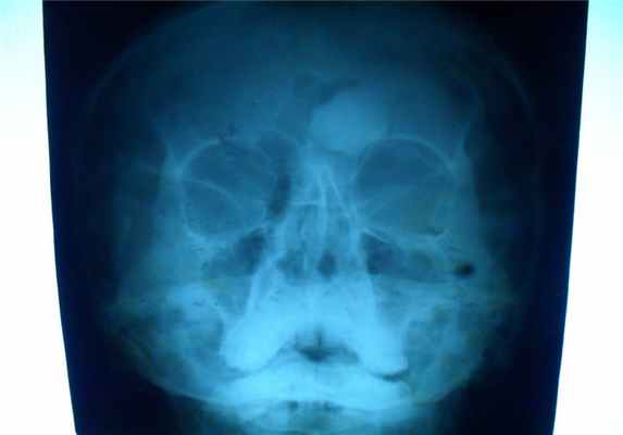 Новообразования костей2.jpg