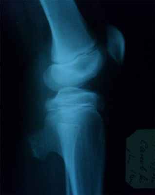 Новообразования костей1.jpg