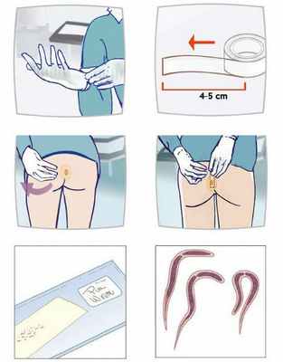 Перианальный соскоб на энтеробиоз