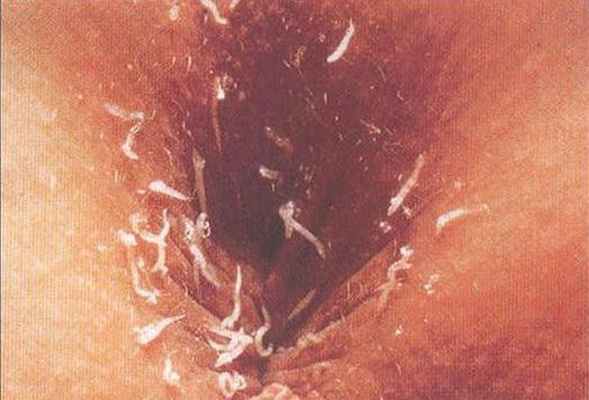 Острицы в перианальных складках