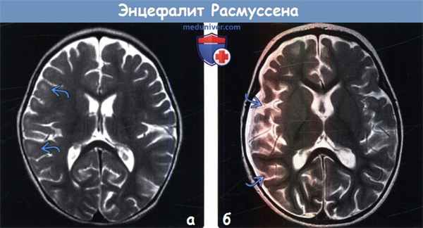 Энцефалит Расмуссена на МРТ