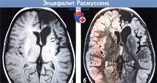 Энцефалит Расмуссена на МРТ